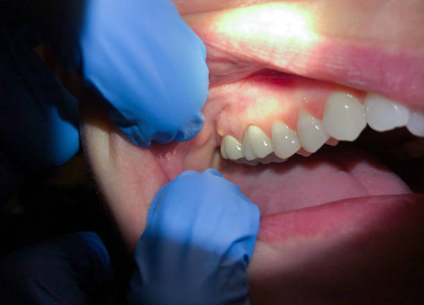 Best Tooth Infection Emergency Dentist  in Gaffney, SC
